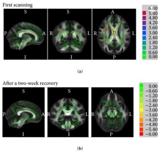 IRMf avant et après deux semaines d'acupuncture - analyse de la FA.