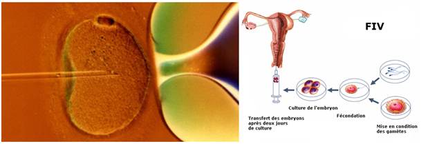 Dans les fécondations in vitro, l'acupuncture augmente le pourcentage de grossesse clinique