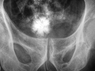 Lithiase vésicale. Iconographie de Nevit Dilmen sous licence CC BY-SA 3.0 disponible http://commons.wikimedia.org/wiki/File :Bladder_Stone_08783.jpg#mediaviewer/File :Bladder_Stone_08783.jpg Lithiase vésicale. Iconographie de Nevit Dilmen sous licence CC BY-SA 3.0 disponible http://commons.wikimedia.org/wiki/File :Bladder_Stone_08783.jpg#mediaviewer/File :Bladder_Stone_08783.jpg