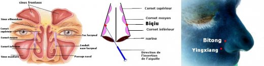 Localisation des points 20GI (yingxiang), EX-HN8 (shangyingxiang encore dénommé bitong) et biqiu. Le point biqiu est situé à l'intérieur du nez. Pour le localiser, le patient doit se tenir droit avec la tête légèrement tournée en arrière. Tenir le champ nasal dans la main gauche. Exposez entièrement le passage nasal tandis que la main droite maintient l'aiguille (voir schéma central). Puis puncturez le point sur 0,5 cm pour les patients obèses ; 0,1 à 0,2 mm pour les autres.