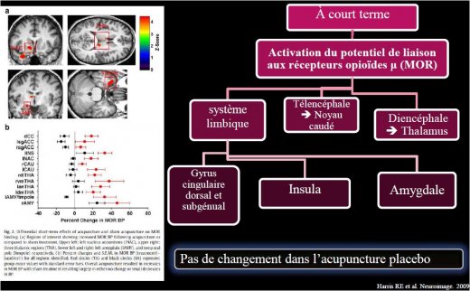 L'imagerie par TEP permet de visualiser les aires cérébrales impliquées Points rouges  acupuncture réelle : augmentation de la liaison aux récepteurs MOR  correspond à activation Endorphines (α,β,γ endorphines) et Endomorphines 1 et 2