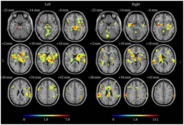 Activation du cerveau pendant la stimulation de l'acupuncture sur le 34VB droit ou gauche (test d'un échantillon t-test avec niveau de cluster corrigé p<0,005). Les barres montrent la valeur.