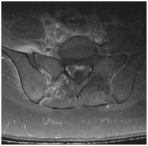 L'imagerie par résonance magnétique du bassin montrant l'élargissement de l'espace articulaire sacro-iliaque droit avec œdème articulaire et présence importante de liquide, le tout associé à des phénomènes inflammatoires allant jusqu'à la limite postérieure du muscle psoas droit et des muscles paravertébraux du côté droit, ainsi que des signes d'ostéomyélite de l'os iliaque et du sacrum adjacents.